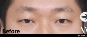 Before