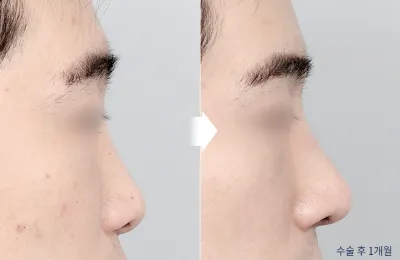 Before & After