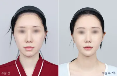Before & After