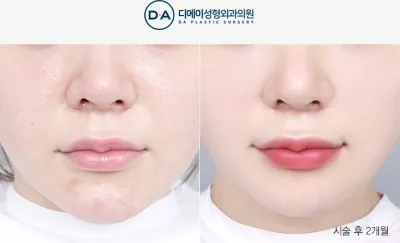 Before & After