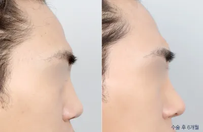 Before & After