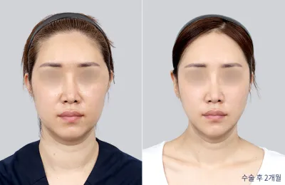 Before & After