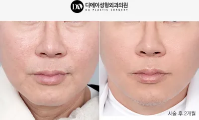 Before & After