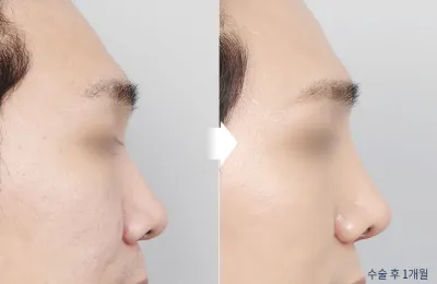 Before & After