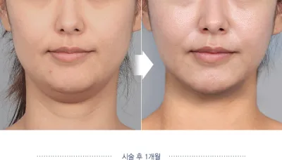 Before & After