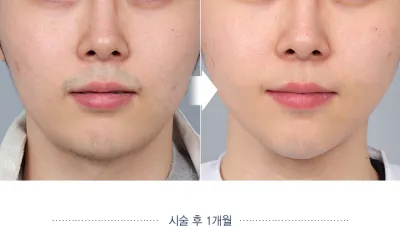 Before & After