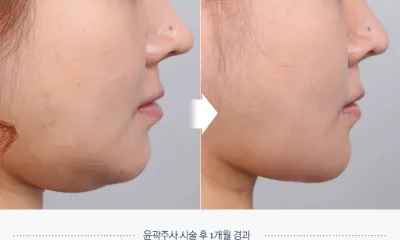 Before & After