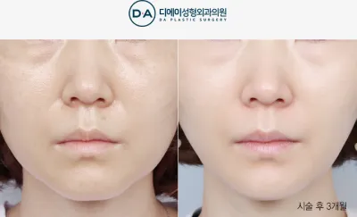 Before & After