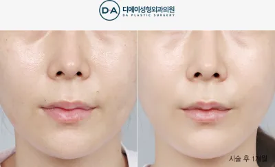 Before & After