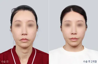 Before & After