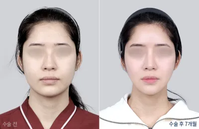 Before & After