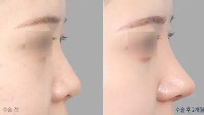 Before & After