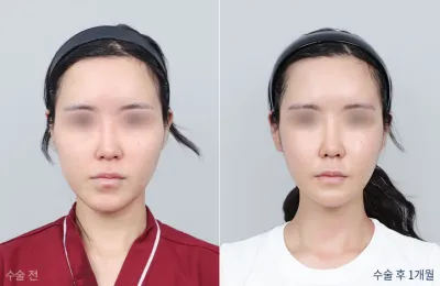 Before & After