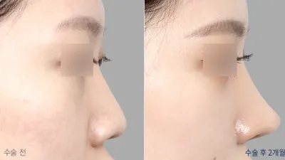 Before & After