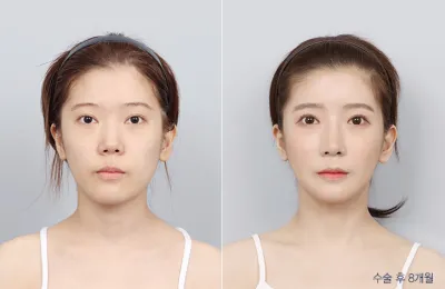 Before & After