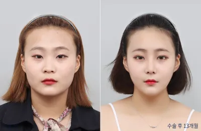 Before & After