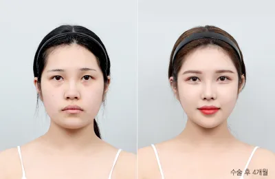 Before & After