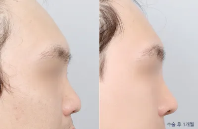 Before & After