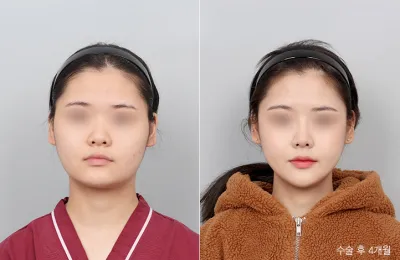 Before & After