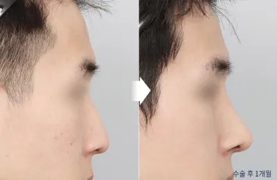 Before & After