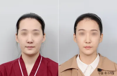 Before & After