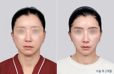 Before & After