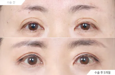 Before & After