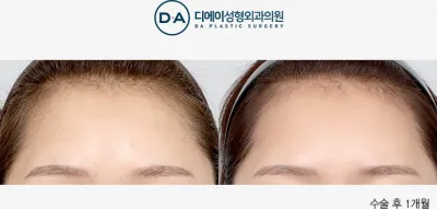 Before & After