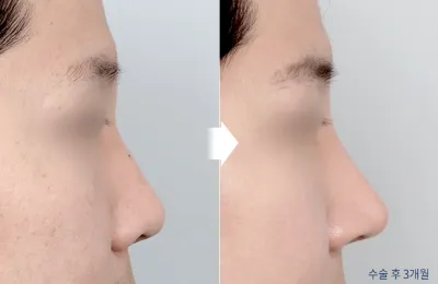 Before & After