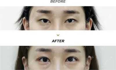 Before & After
