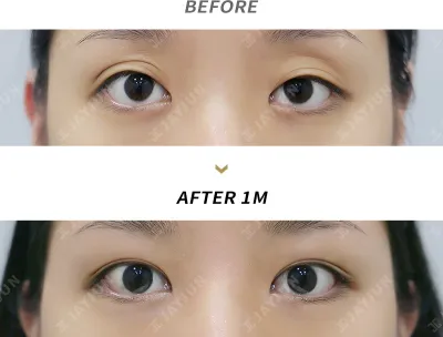 Before & After