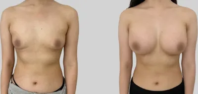 Before & After