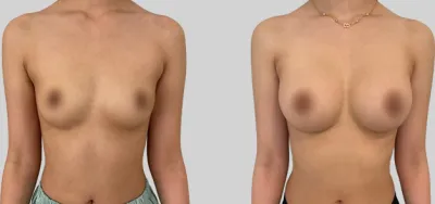 Before & After