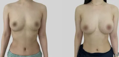 Before & After