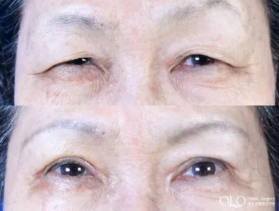 Before & After