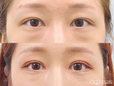 Before & After
