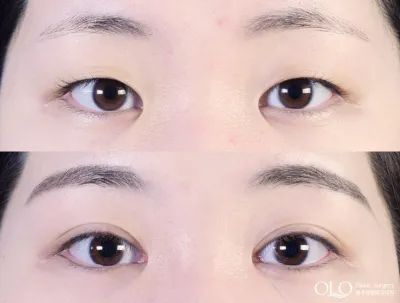 Before & After