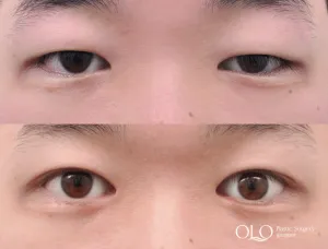 Before