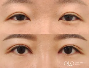 Before