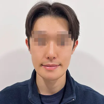 안면윤곽 코수술 함께 받았습니다!