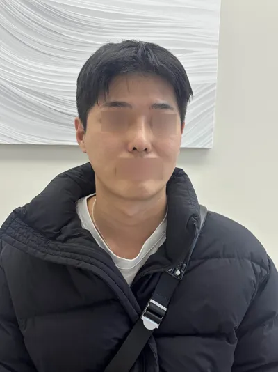 남자 코 재수술 리뷰!!