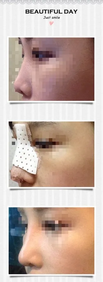 코 수술한지 10일째!!!