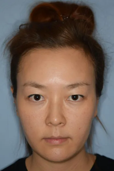 수술한지 벌써 3개월이 지났네요 여기저기 병원을 꼽꼽히 알아보고 찾아가보고 상담도 해보고... 근데 별로 끌림은 없었어요 수술을 해야겠다는 확신은 반반이였으니까요 잘못해서 부작용나