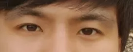 안녕하세요^^ 에이펙스에서 비절개눈매교정 수술한 준석이에요~~