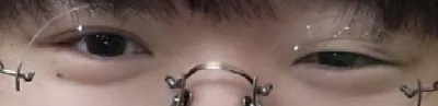 짝눈 교정