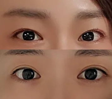눈재수술