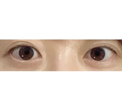 눈매교정 너무 자연스럽네요!