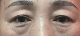 눈썹하거상 하안검 후기