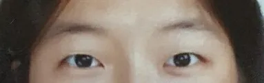 첫 쌍커풀 수술 후기