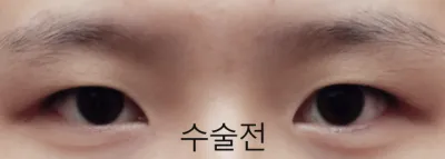 절개눈매교정+앞뒤밑트임 솔직후기!!
